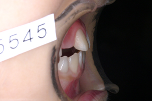 下顎前突症　3-4