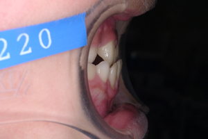 下顎前突症-2