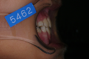 下顎前突症　2-6